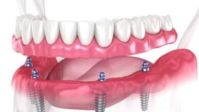 Dental Implants