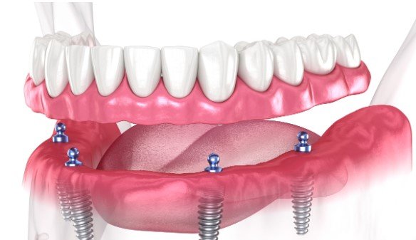 Dental Implants