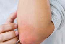 Psoriasis v Eczema: Getting the Right Care for the Right Condition