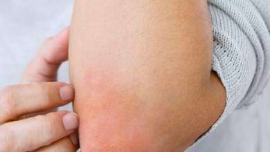 Psoriasis v Eczema: Getting the Right Care for the Right Condition