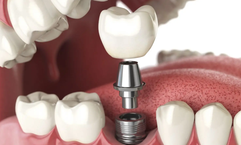 5 Ways Periodontics And Implant Dentistry Restore Healthy Smiles