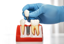 Why More Adults Are Turning To Dental Implants For Tooth Replacement