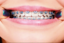 6 Tips For Maintaining Gum Health During Orthodontic Treatment