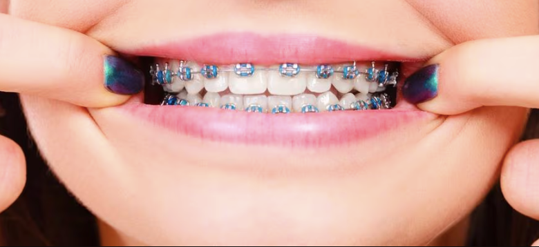 6 Tips For Maintaining Gum Health During Orthodontic Treatment