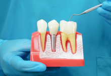 Why Implants Are The Foundation Of Many Cosmetic Dental Treatments