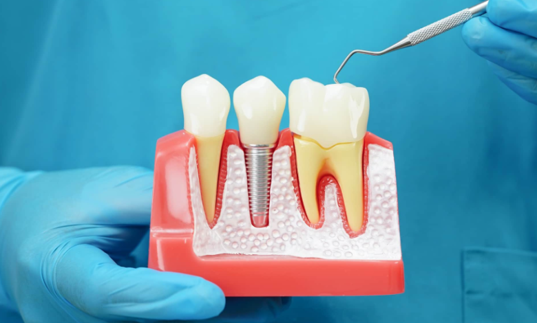 Why Implants Are The Foundation Of Many Cosmetic Dental Treatments