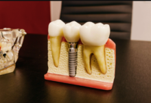 3 Questions To Ask Before Getting Dental Implants