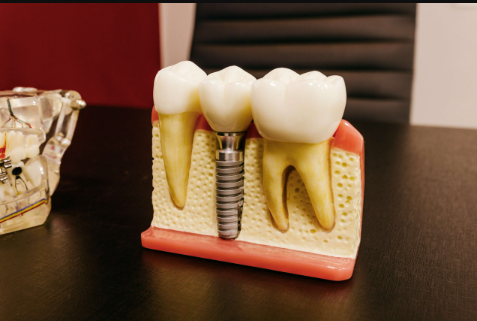 3 Questions To Ask Before Getting Dental Implants