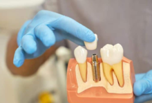 How Oral Surgeons Personalize Implant Procedures For Each Patient