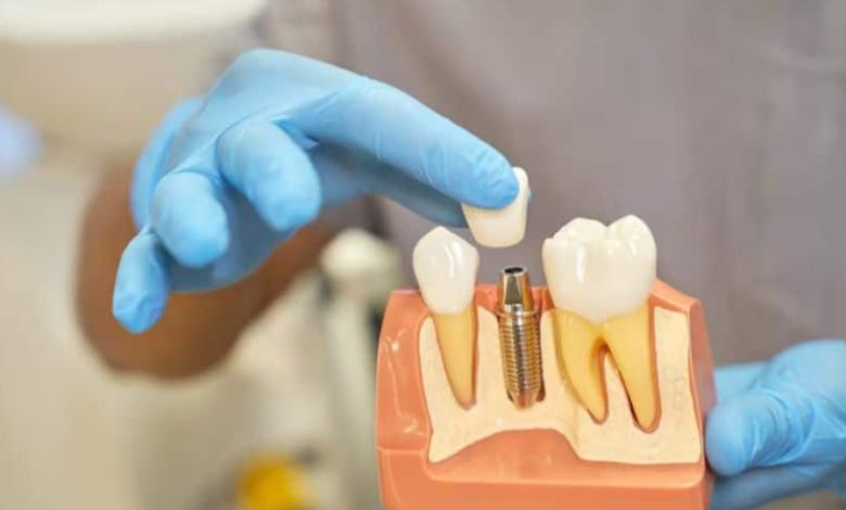 How Oral Surgeons Personalize Implant Procedures For Each Patient