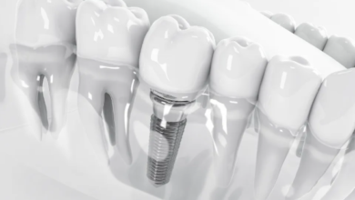 4 Common Misconceptions About Implant Dentistry