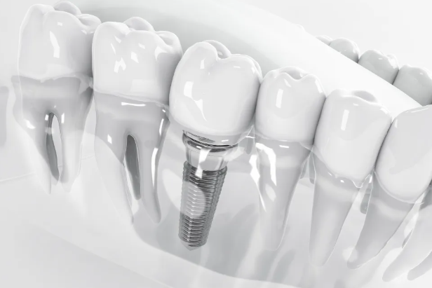 4 Common Misconceptions About Implant Dentistry