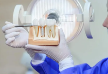 Why Implant Dentistry Is The Gold Standard For Tooth Replacement