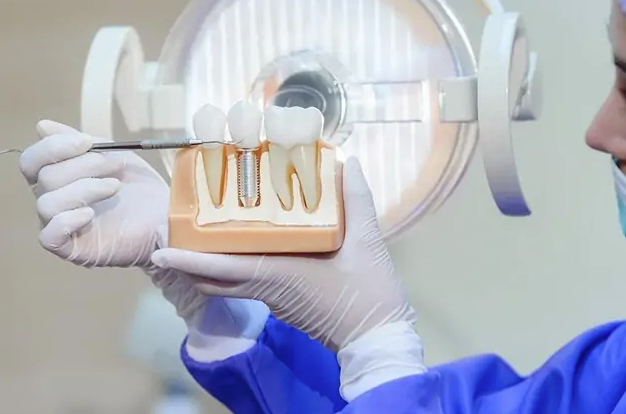 Why Implant Dentistry Is The Gold Standard For Tooth Replacement